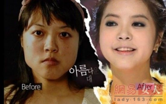 丑女變靚妹！韓國(guó)整容節(jié)目爆紅