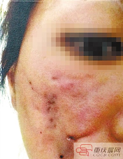 重慶美女手術(shù)后臉蛋腫脹發(fā)紫 整形門診被判補(bǔ)償12萬5
