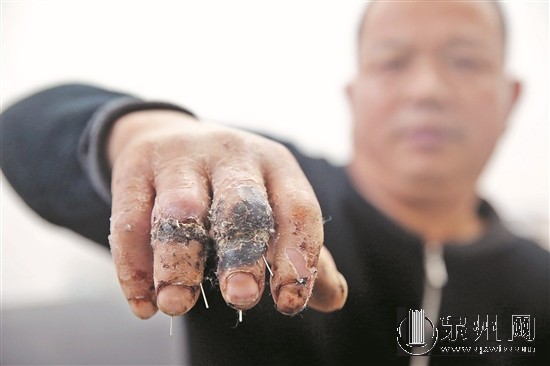 患者投訴醫(yī)院中指無(wú)名指錯(cuò)接 醫(yī)院：要等鑒定結(jié)果