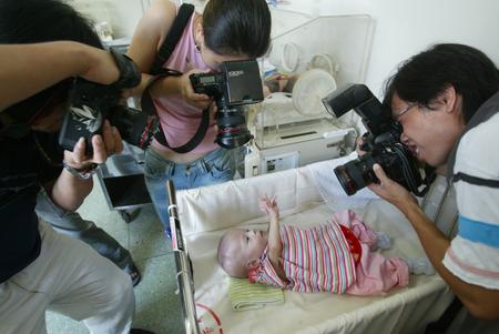 ,,Hu Jingyi,,,conjoined twins,,,