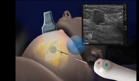 不開刀無疤痕 以色列科學家開發(fā)乳腺癌“冰球”療法