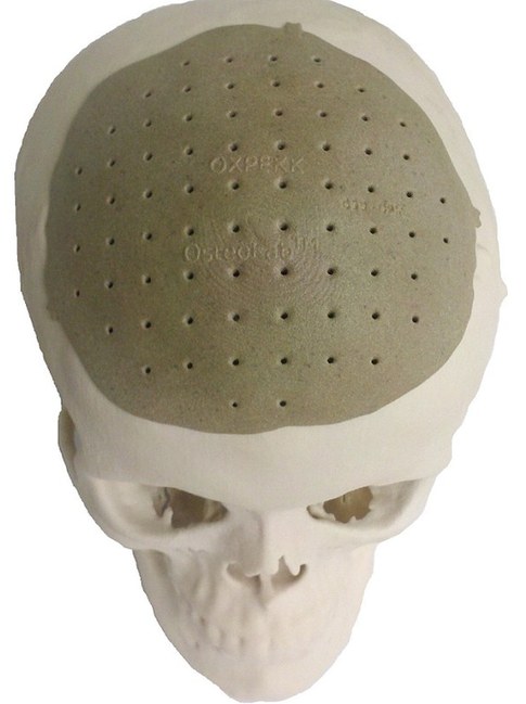 頭骨也能打??！美國(guó)3D打印技術(shù)造福移植患者