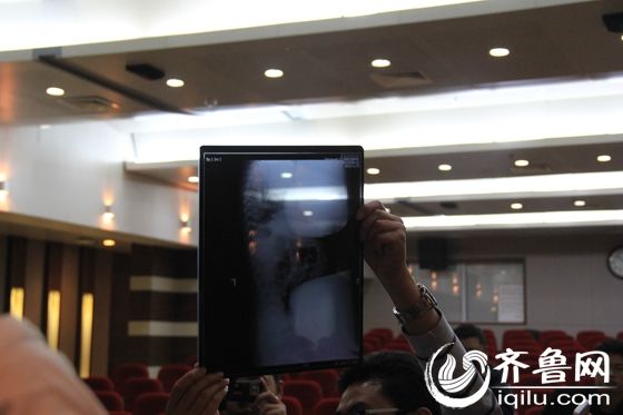 聊城針扎女嬰預(yù)計一周內(nèi)康復(fù) 醫(yī)生建議關(guān)注心理問題