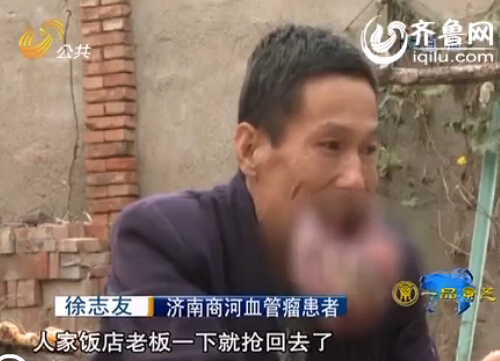 濟南：男子嘴唇長瘤50年未醫(yī)治 唇部腫脹比臉大