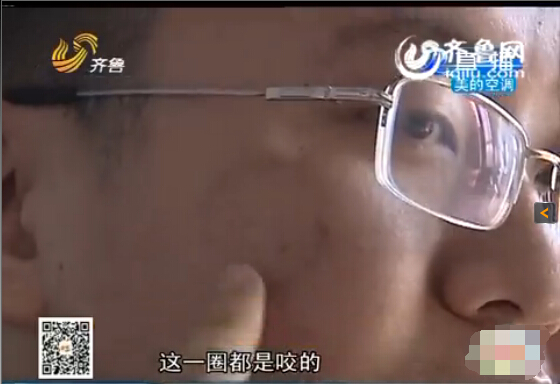 東營：男子與同事辦公室打架被咬臉 對(duì)方拒絕賠償