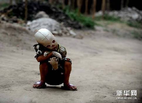 山西“面具娃娃”已回家養(yǎng)傷 氣管還存問(wèn)題(圖)