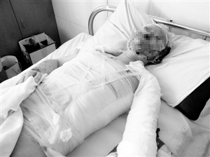 女孩拒絕前男友求婚被潑硫酸 面部無(wú)完整地方