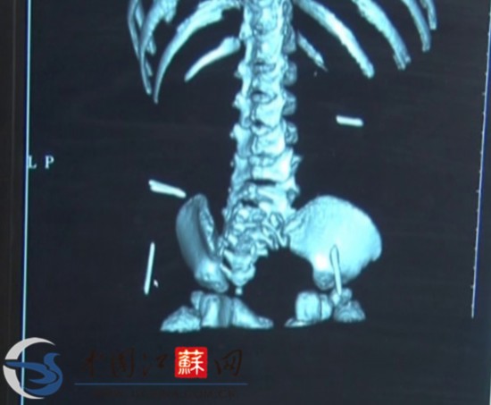 江蘇淮安女嬰體內(nèi)取出4根縫衣針 或為人為扎入