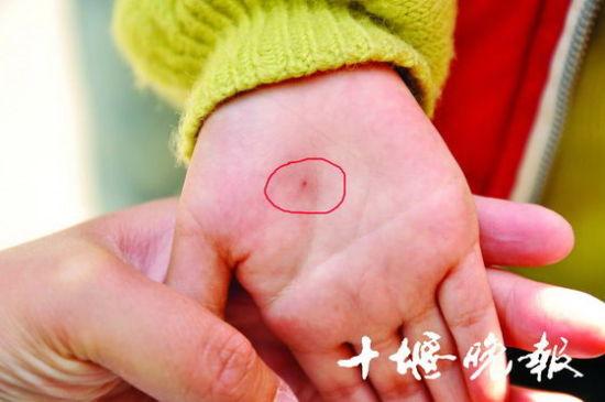 十堰兩歲男童遭老師用針扎手 老師稱(chēng)體驗(yàn)式教學(xué)(圖)