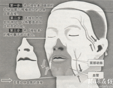 世界首例換臉手術(shù)“完美”成功(多圖)