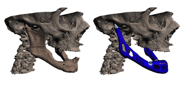 骨科治療新突破：世界首例3D打印下頜移植手術(shù)細節(jié)公布