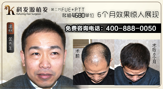 植發(fā)效果怎么樣 植發(fā)效果評(píng)估