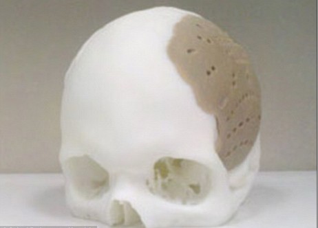美國公司用3D打印技術(shù)為病人移植頭骨