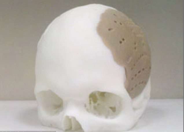 頭骨也能打??！美國(guó)3D打印技術(shù)造福移植患者