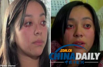 智利少女患罕見(jiàn)疾病 眼睛流血不流淚