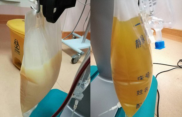 中山男子腹痛緊急送醫(yī)搶救，檢出“牛奶血”！